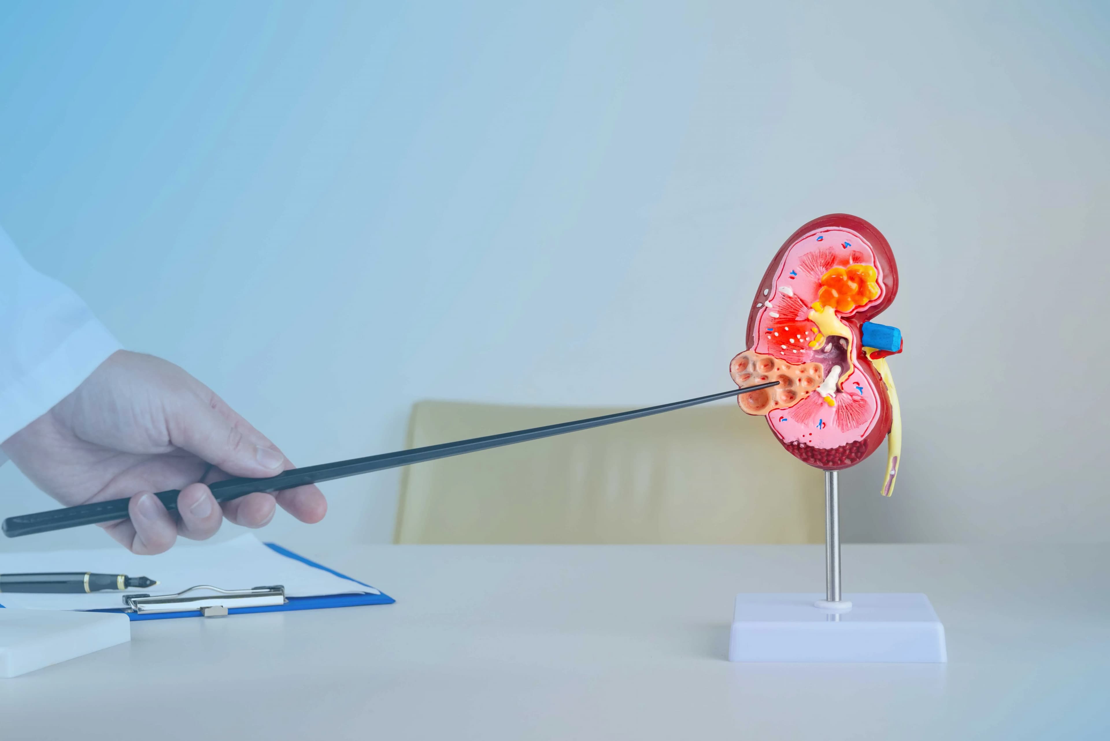 Uric Acid Stones – Causes, Prevention, and Treatment